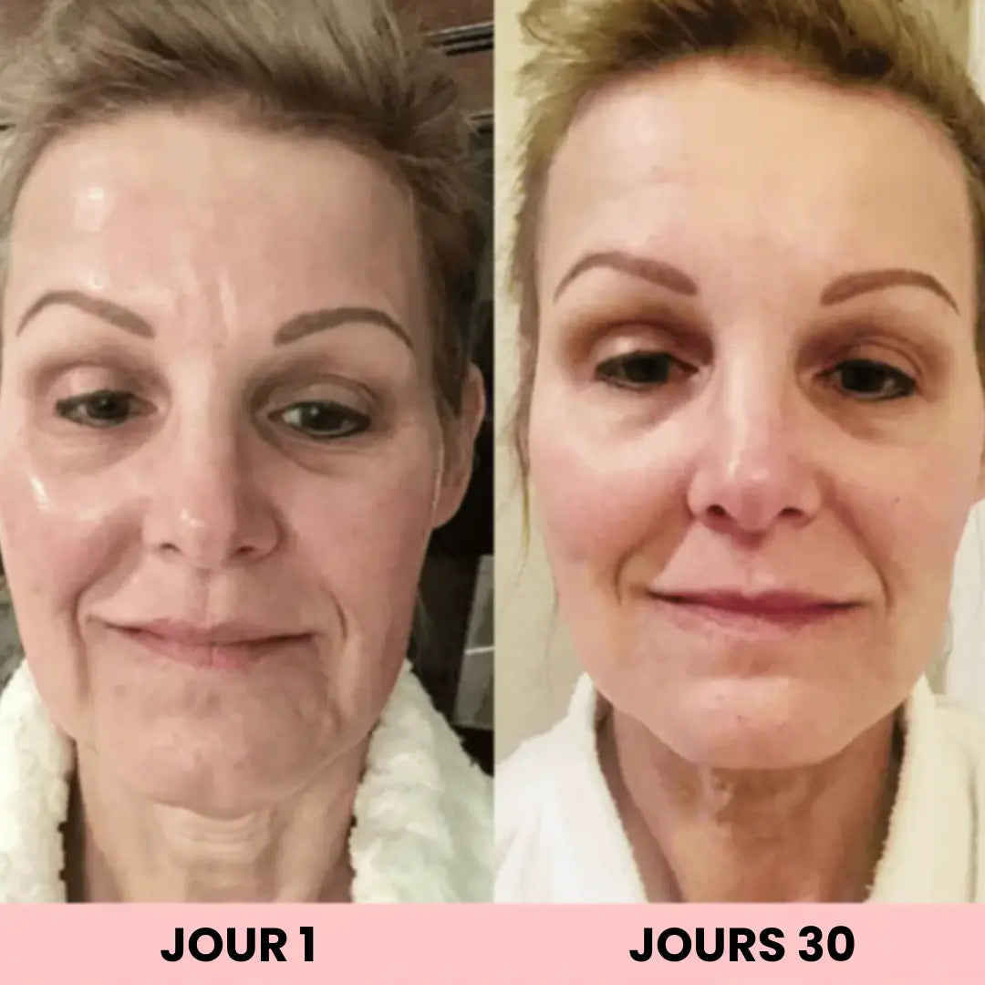 ScultTech Pro : Micro-Lifting SkinTech Paris