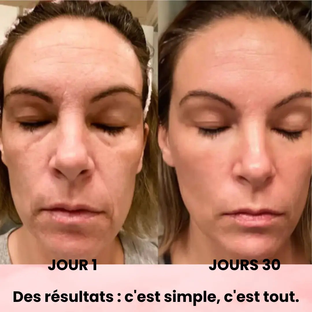 ScultTech Pro : Micro-Lifting SkinTech Paris