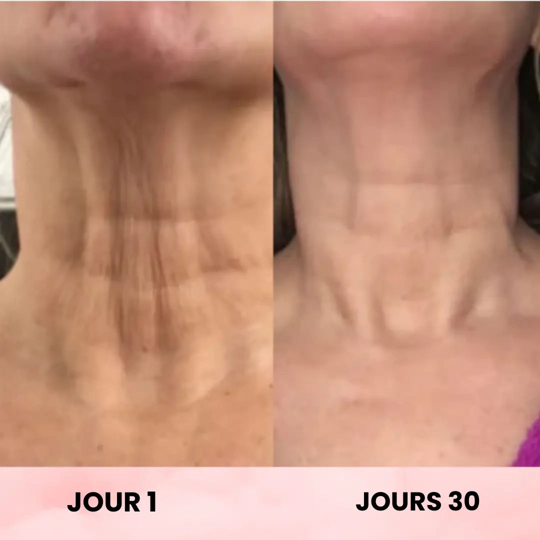 ScultTech Pro : Micro-Lifting SkinTech Paris