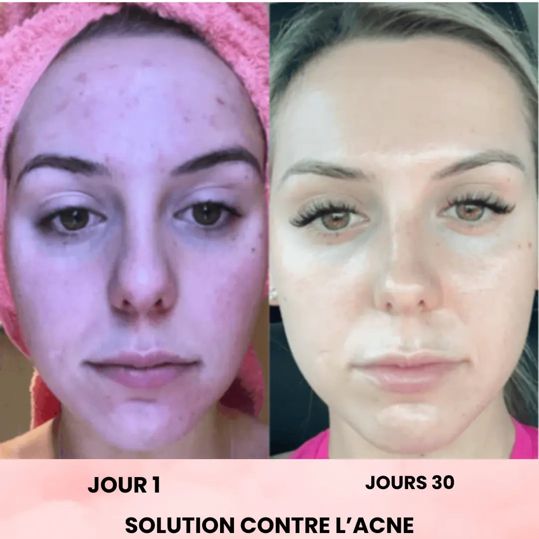 ScultTech Pro : Micro-Lifting SkinTech Paris